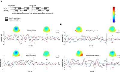 Altered Effective Brain Connectivity During Habituation in First Episode Schizophrenia With Auditory Verbal Hallucinations: A Dichotic Listening EEG Study